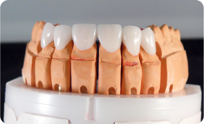 Manufacturing of veneers