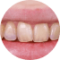 Thinning of enamel